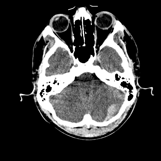 File:Cerebral hemorrhagic contusions- temporal evolution (Radiopaedia 40224-42753 Axial non-contrast 7).png