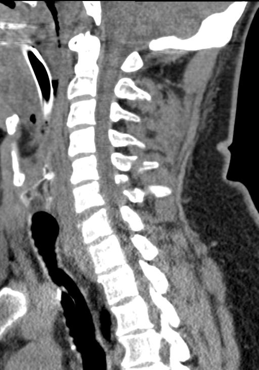 Cerebral hemorrhagic contusions and cervical spine fractures (Radiopaedia 32865-33841 G 62).jpg