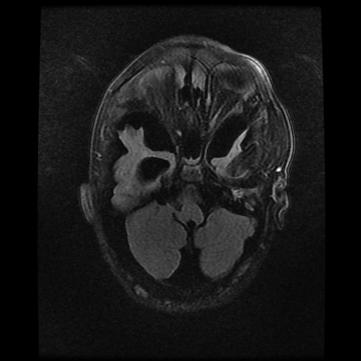 File:Cerebral manifestations of mucopolysaccharidosis type I (Radiopaedia 59171-66487 Axial FLAIR 4).jpg