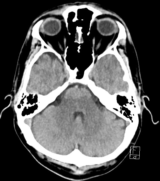 Cerebral metastases - testicular choriocarcinoma (Radiopaedia 84486-99855 Axial non-contrast 40).jpg