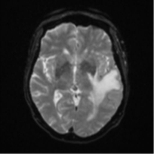Cerebral metastasis (Radiopaedia 46744-51248 Axial DWI 13).png