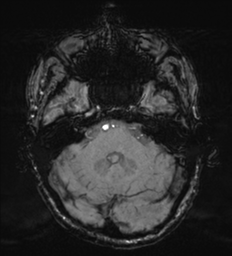 Cerebral metastasis - melanoma (Radiopaedia 54718-60954 Axial SWI 14).png