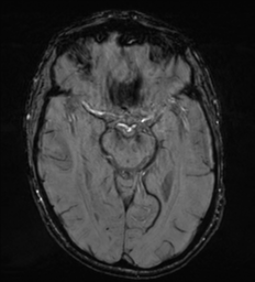 Cerebral metastasis - melanoma (Radiopaedia 54718-60954 Axial SWI 24).png