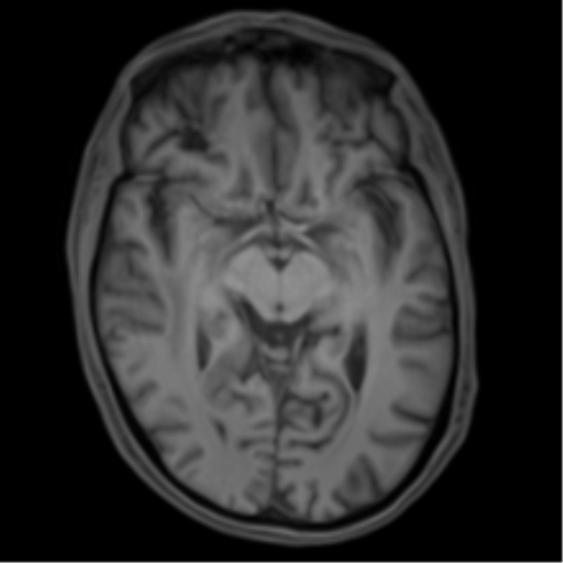 Cerebral metastasis - melanoma (Radiopaedia 54718-60954 Axial T1 24).png