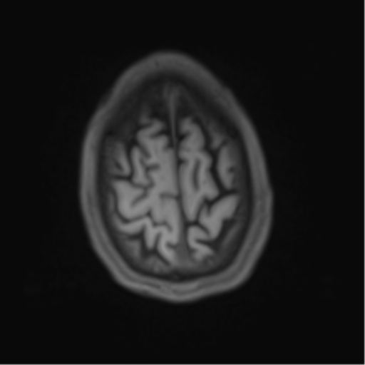 Cerebral metastasis - melanoma (Radiopaedia 54718-60954 Axial T1 46).png