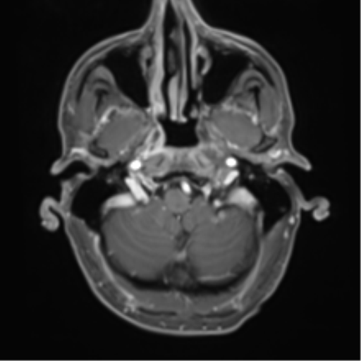 File:Cerebral metastasis - melanoma (Radiopaedia 54718-60954 Axial T1 C+ fat sat 9).png