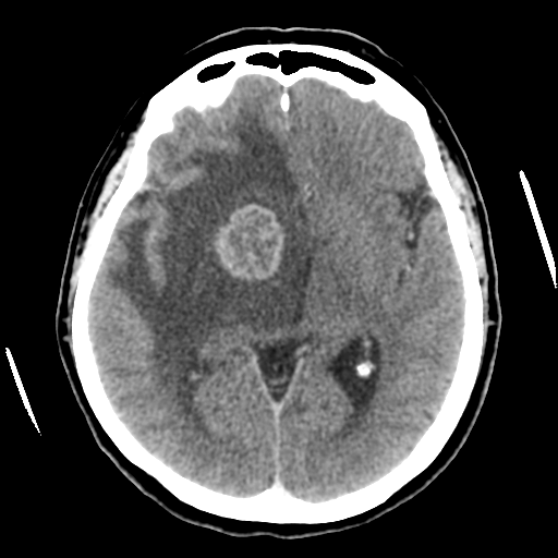 Cerebral metastasis to basal ganglia (Radiopaedia 81568-95412 Axial C+ delayed 29).png