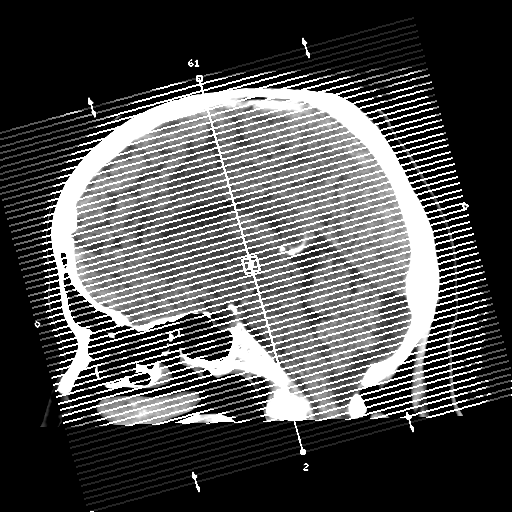 Cerebral metastasis to basal ganglia (Radiopaedia 81568-95412 Axial non-contrast 1).png