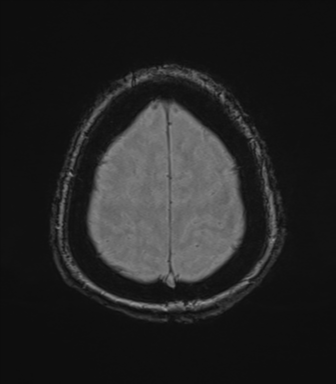 Cerebral metastasis to basal ganglia (Radiopaedia 81568-95413 Axial SWI magnitude 77).png