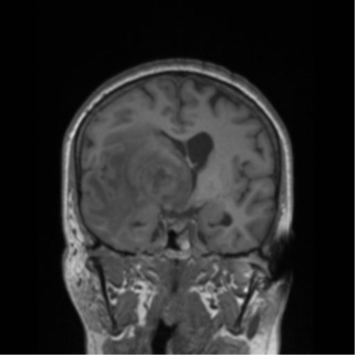Cerebral metastasis to basal ganglia (Radiopaedia 81568-95413 Coronal T1 31).png