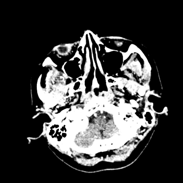 File:Cerebral ring enhancing lesions - cerebral metastases (Radiopaedia 44922-48818 B 38).jpg