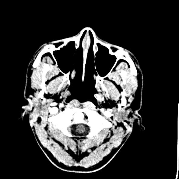 Cerebral toxoplasmosis (Radiopaedia 53993-60131 Axial C+ delayed 2).jpg