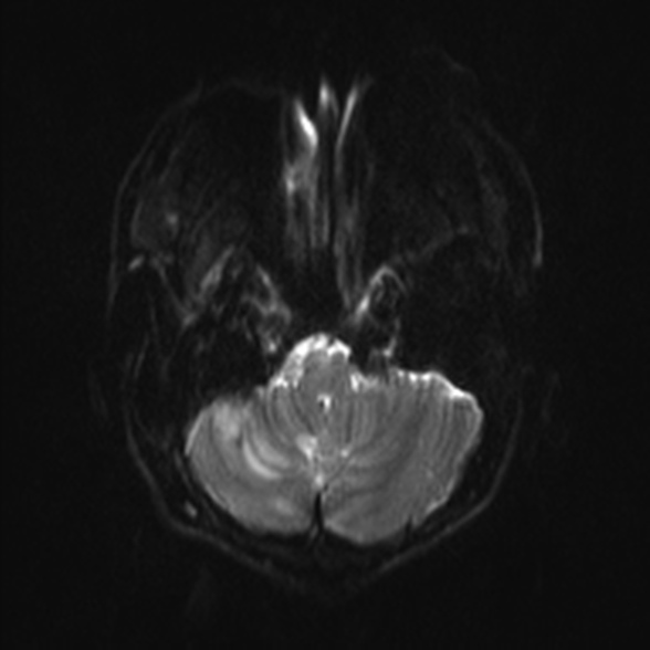 Cerebral toxoplasmosis (Radiopaedia 53993-60132 Axial DWI 4).jpg