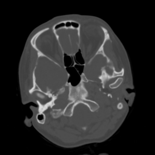 Cerebral tuberculosis with dural sinus invasion (Radiopaedia 60353-68018 Axial bone window 6).jpg