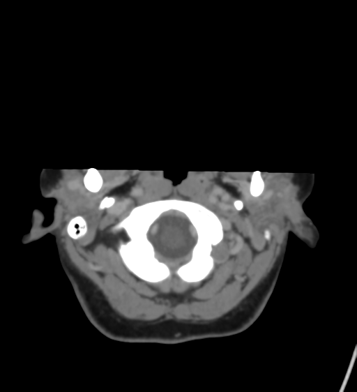 Cerebral venous infarction due to transverse sinus thrombosis (Radiopaedia 34688-36120 Axial CT venogram 6).png