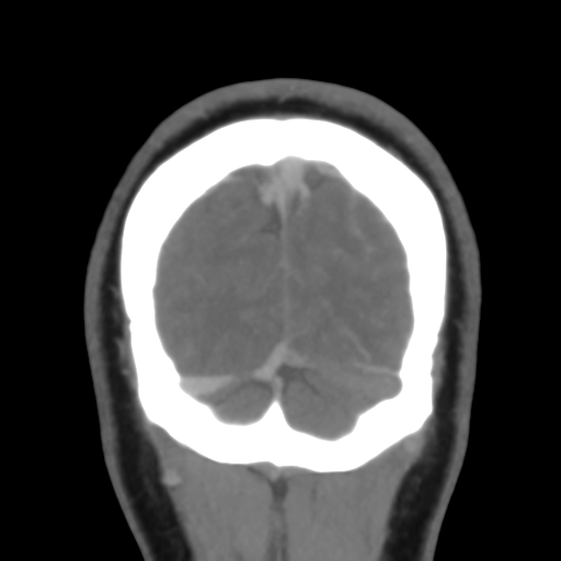 File:Cerebral venous infarction due to transverse sinus thrombosis (Radiopaedia 34688-36120 Coronal 54).png