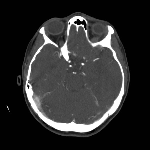 Cerebral venous sinus thrombosis (Radiopaedia 40619-43227 A 81).jpg