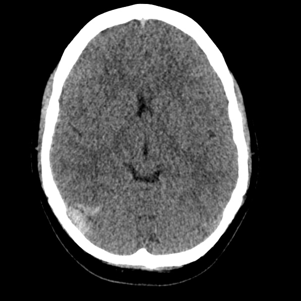 Cerebral venous sinus thrombosis (Radiopaedia 59224-66551 Axial non-contrast 8).jpg