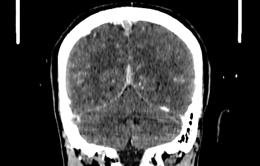 Cerebral venous thrombosis (CVT) (Radiopaedia 77524-89685 C 48).jpg
