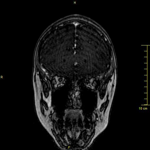 Cerebral venous thrombosis (Radiopaedia 23288-23351 MRV 18).JPG