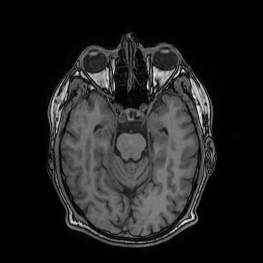 File:Cerebral venous thrombosis with secondary intracranial hypertension (Radiopaedia 89842-106957 Axial T1 74).jpg