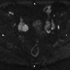 File:Cervical adenocarcinoma (Radiopaedia 65011-73985 Axial DWI 56).jpg