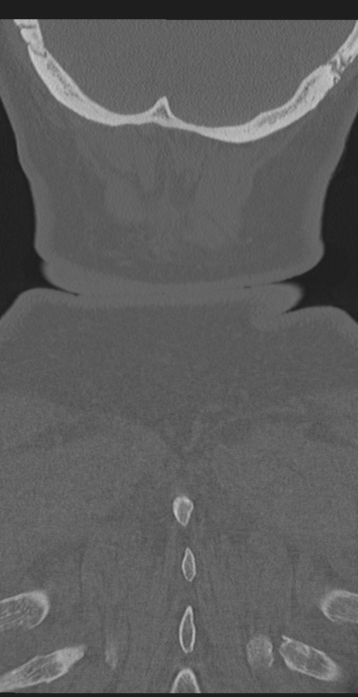 Cervical canal stenosis due to ossification of the posterior longitudinal ligament (Radiopaedia 47260-51823 Coronal bone window 68).png