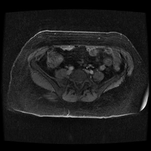Cervical carcinoma (Radiopaedia 70924-81132 Axial T1 C+ fat sat 258).jpg