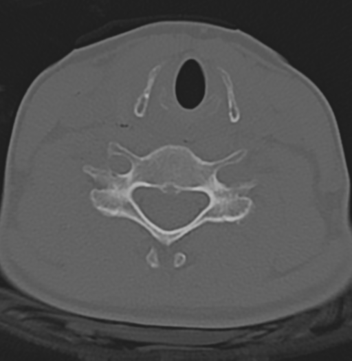 File:Cervical disc replacement (Radiopaedia 37383-39205 Axial bone window 7).png