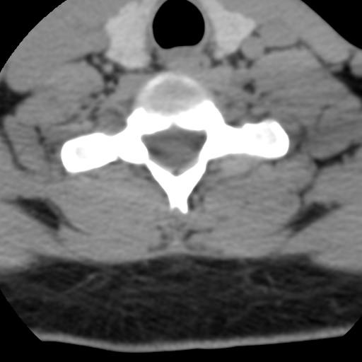Cervical schwannoma (Radiopaedia 57979-64974 Axial non-contrast 51).png