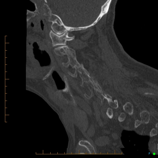 Cervical spine fracture - ankylosing spondylitis (Radiopaedia 76835-88706 Sagittal bone window 80).jpg