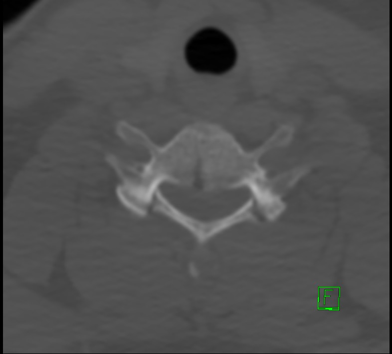 Cervical spine fracture - hyperflexion injury (Radiopaedia 66184-75364 Axial bone window 38).jpg