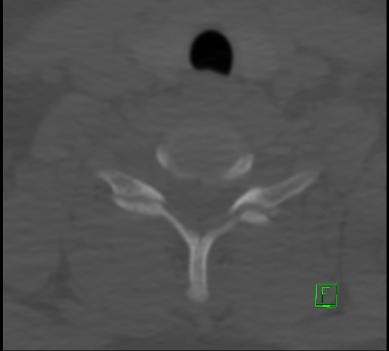 Cervical spine fracture - hyperflexion injury (Radiopaedia 66184-75364 Axial bone window 43).jpg