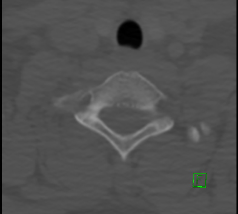 Cervical spine fracture - hyperflexion injury (Radiopaedia 66184-75364 Axial bone window 47).jpg