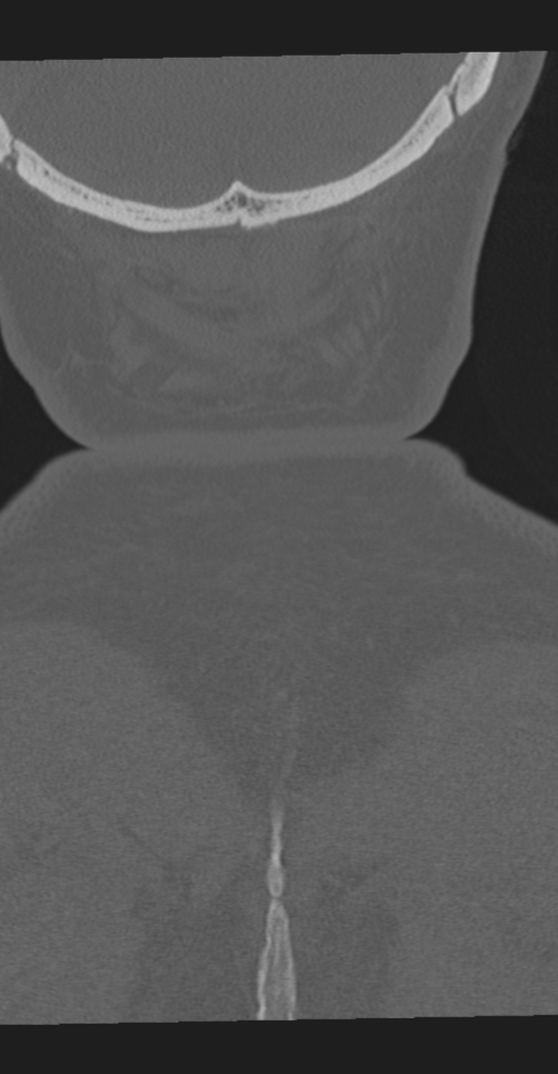 Cervical spine fracture in the setting of ankylosis (Radiopaedia 37038-38715 Coronal bone window 74).png