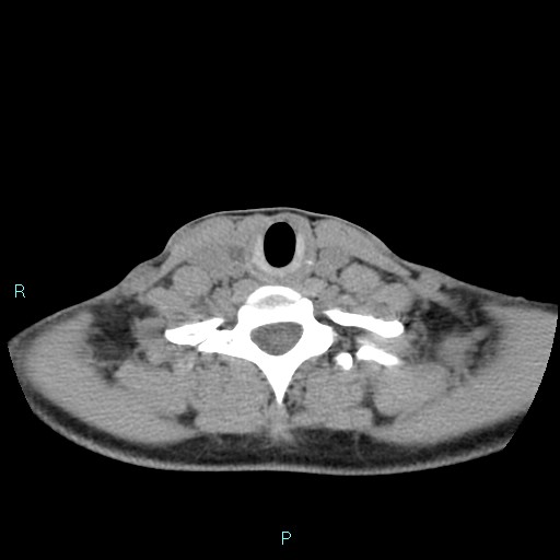 File:Cervical thymic cyst (Radiopaedia 88632-105335 Axial non-contrast 41).jpg