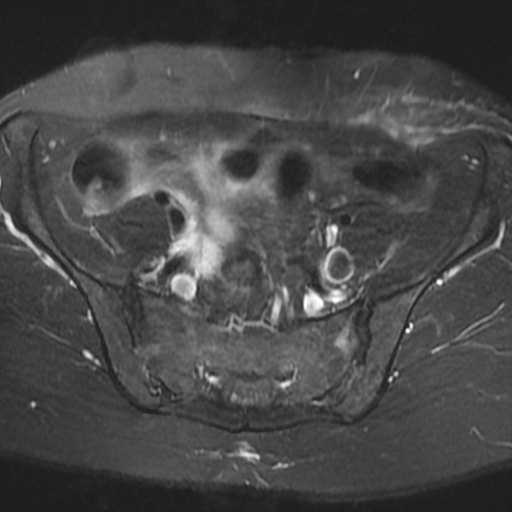 File:Cesarian section scar endometriosis (Radiopaedia 66520-75799 Axial T2 fat sat 4).jpg
