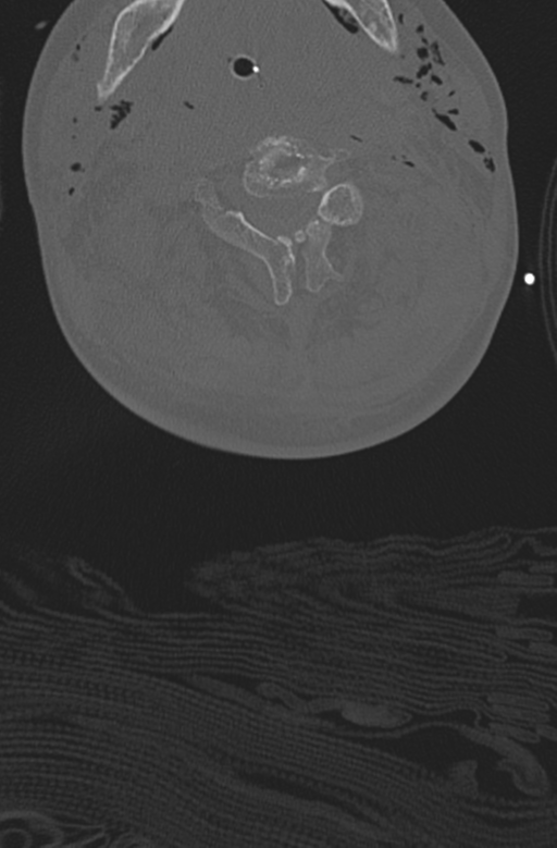 Chalk stick fracture (Radiopaedia 57948-64928 Axial bone window 25).png