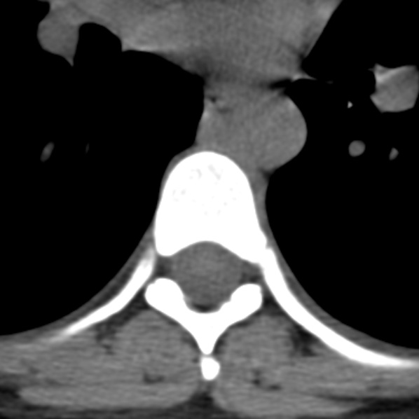 Chance fracture (Radiopaedia 36521-38081 Axial non-contrast 2).jpg