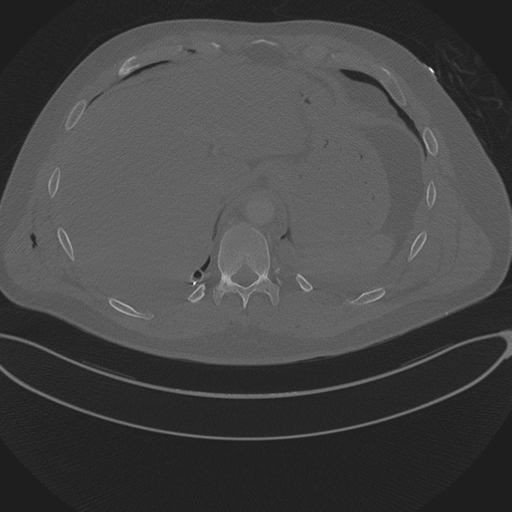 Chest multitrauma - aortic injury (Radiopaedia 34708-36147 Axial bone window 260).png