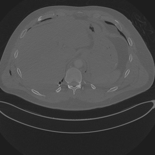 Chest multitrauma - aortic injury (Radiopaedia 34708-36147 Axial bone window 263).png