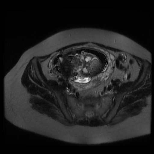 Chiari II malformation - fetal MRI (Radiopaedia 68099-77581 Axial T2-SSFSE 40).jpg