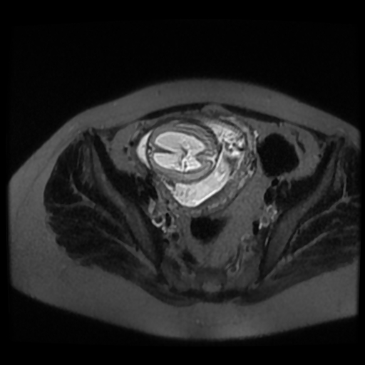 Chiari II malformation - fetal MRI (Radiopaedia 68099-77581 Axial T2-SSFSE 46).jpg
