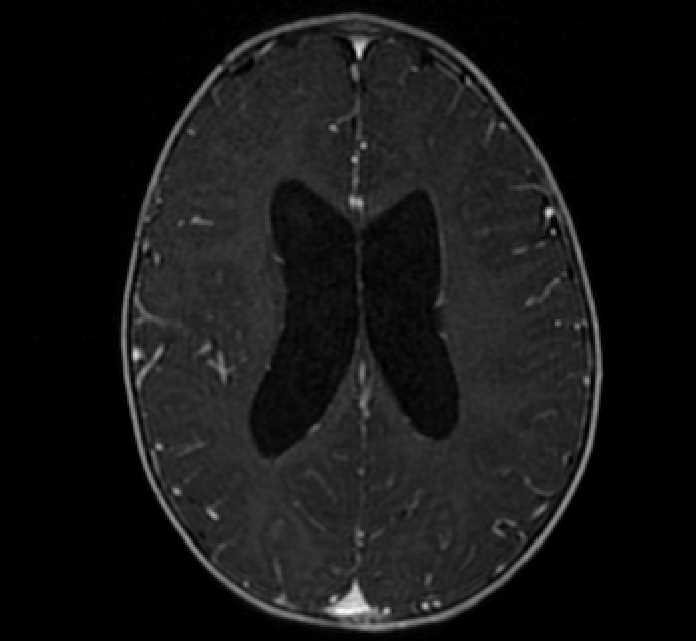 Chiasmatic-hypothalamic glioma (Radiopaedia 90079-107252 Axial T1 C+ 57).jpg