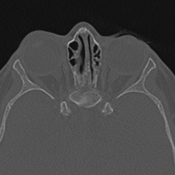 Choanal atresia (Radiopaedia 88525-105975 Axial bone window 89).jpg