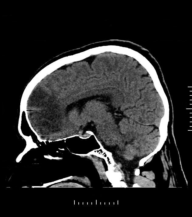 Cholangiocarcinoma with cerebral metastases (Radiopaedia 83519-98628 C 30).jpg