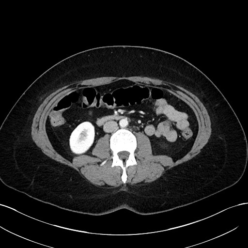 File:Choledocholithiasis after recent cholecystectomy (Radiopaedia 60929-68737 Axial 7).jpg