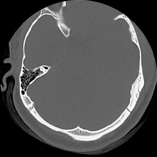 Cholesteatoma (Radiopaedia 84960-100474 Axial bone window 28).jpg