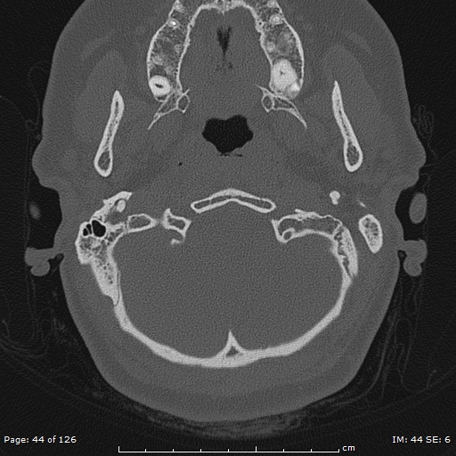 Cholesteatoma - external auditory canal (Radiopaedia 88452-105096 Axial bone window 7).jpg