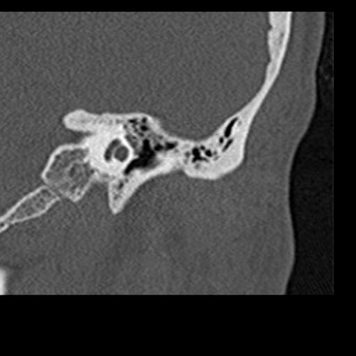 File:Cholesteatoma of the external ear (Radiopaedia 16540-16225 Coronal bone window 7).jpg
